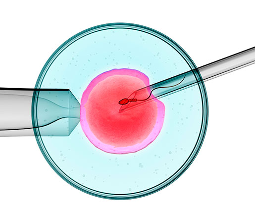 inyección intracitoplasmática