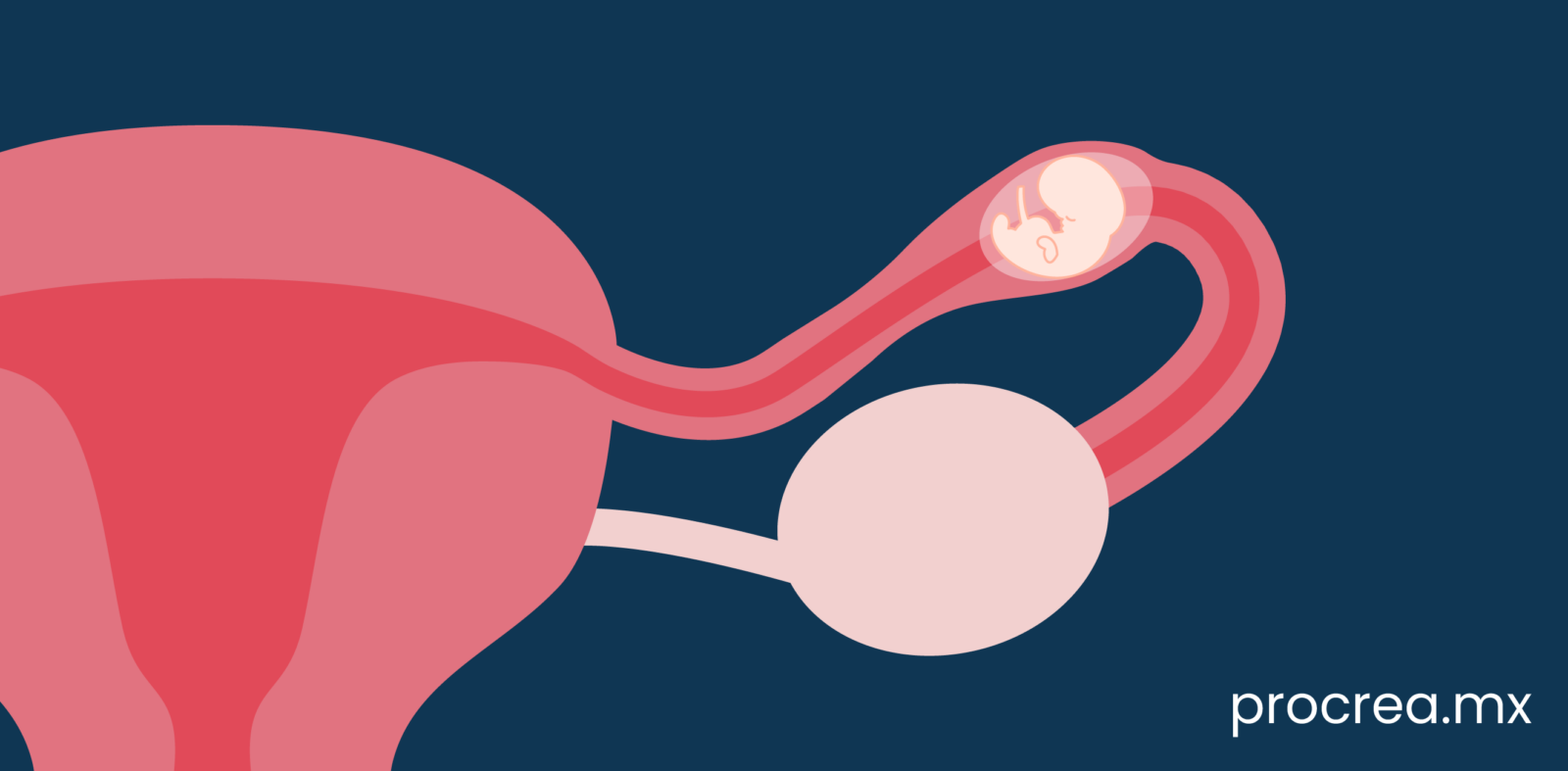 Embarazo Ectópico: Qué Es, Síntomas Y Causas - Braun Papenburg