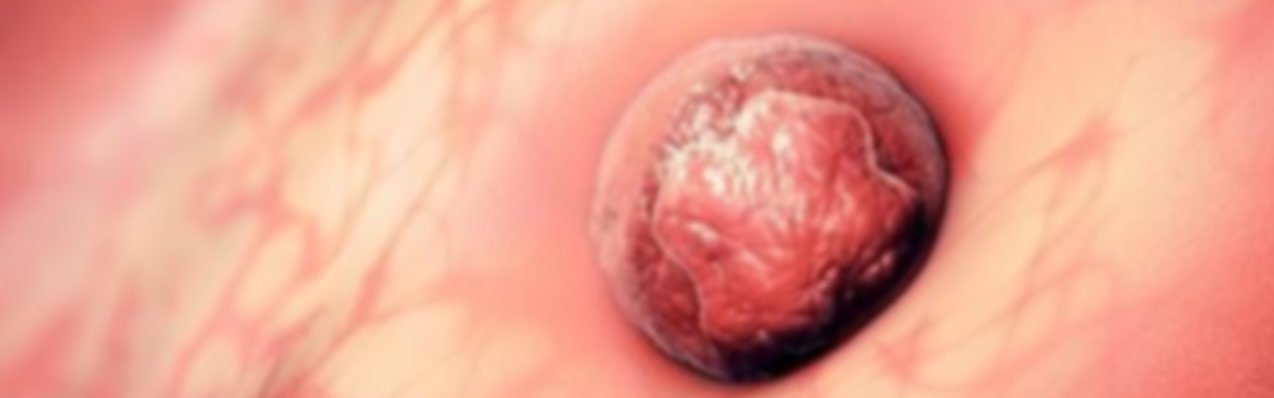 La ventana de implantación en el FIV