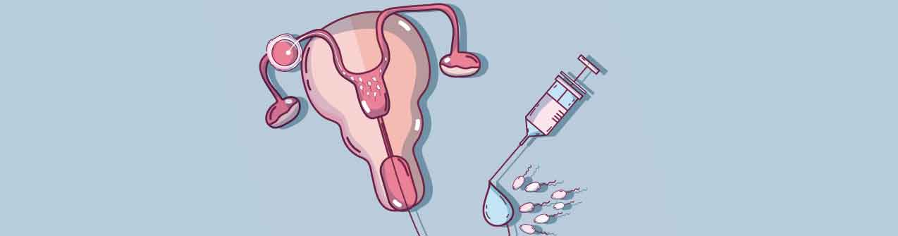 Inseminación intrauterina: ¿Cuándo es una opción?
