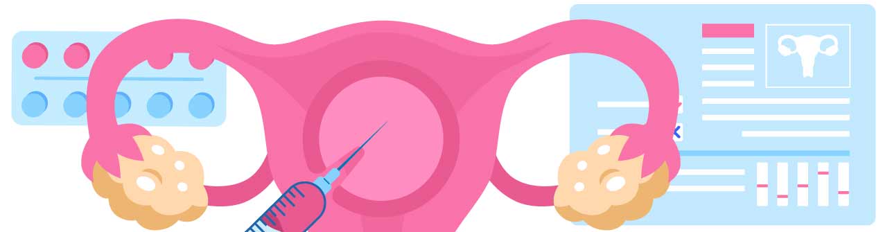 Síndrome de hiperestimulación ovárica y tratamientos de reproducción