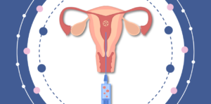inseminaciones intrauterinas