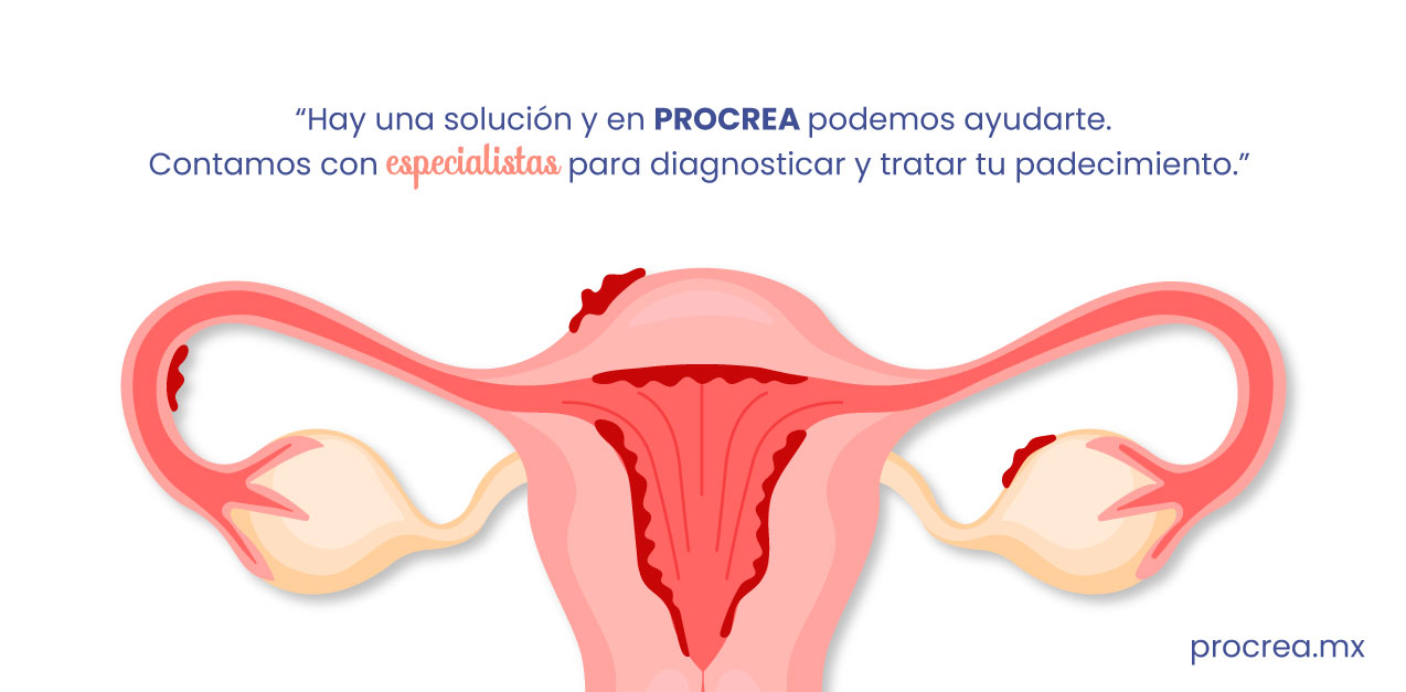 Endometriosis_ Tratamiento