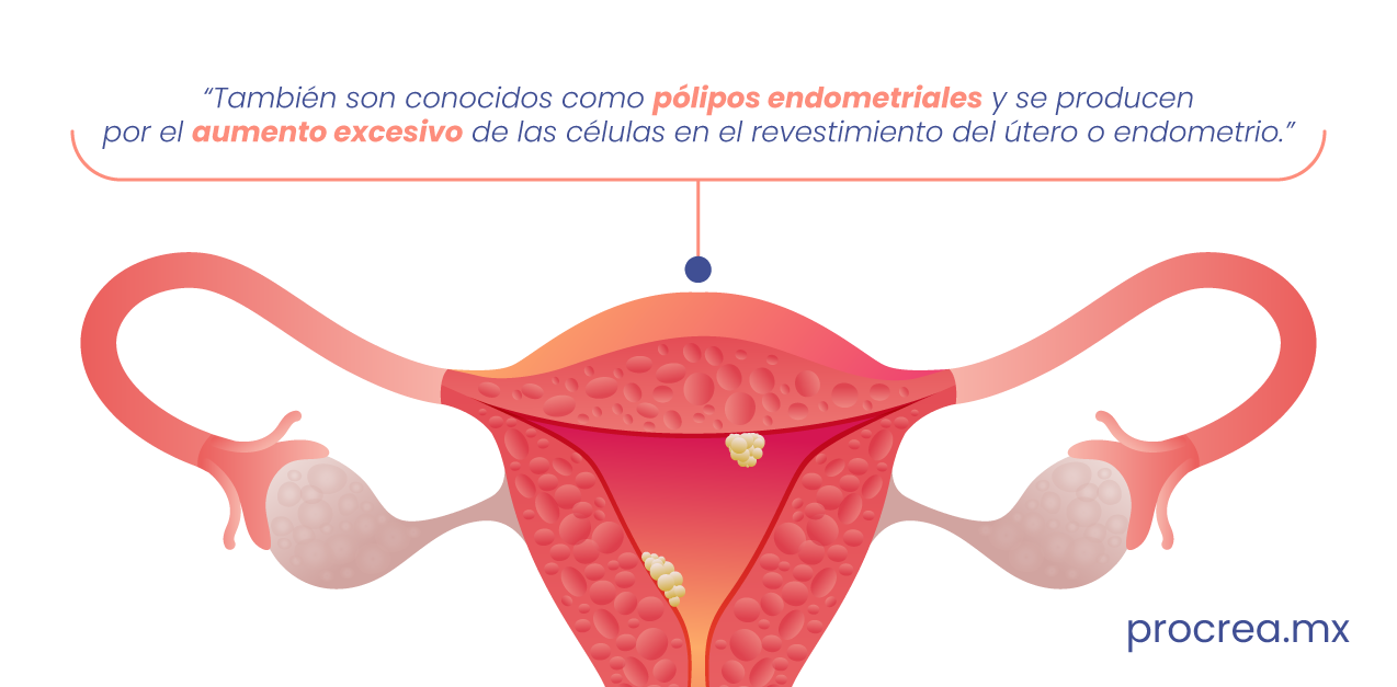 Pólipos Uterinos: ¿Cómo afectan mi fertilidad? | Procrea