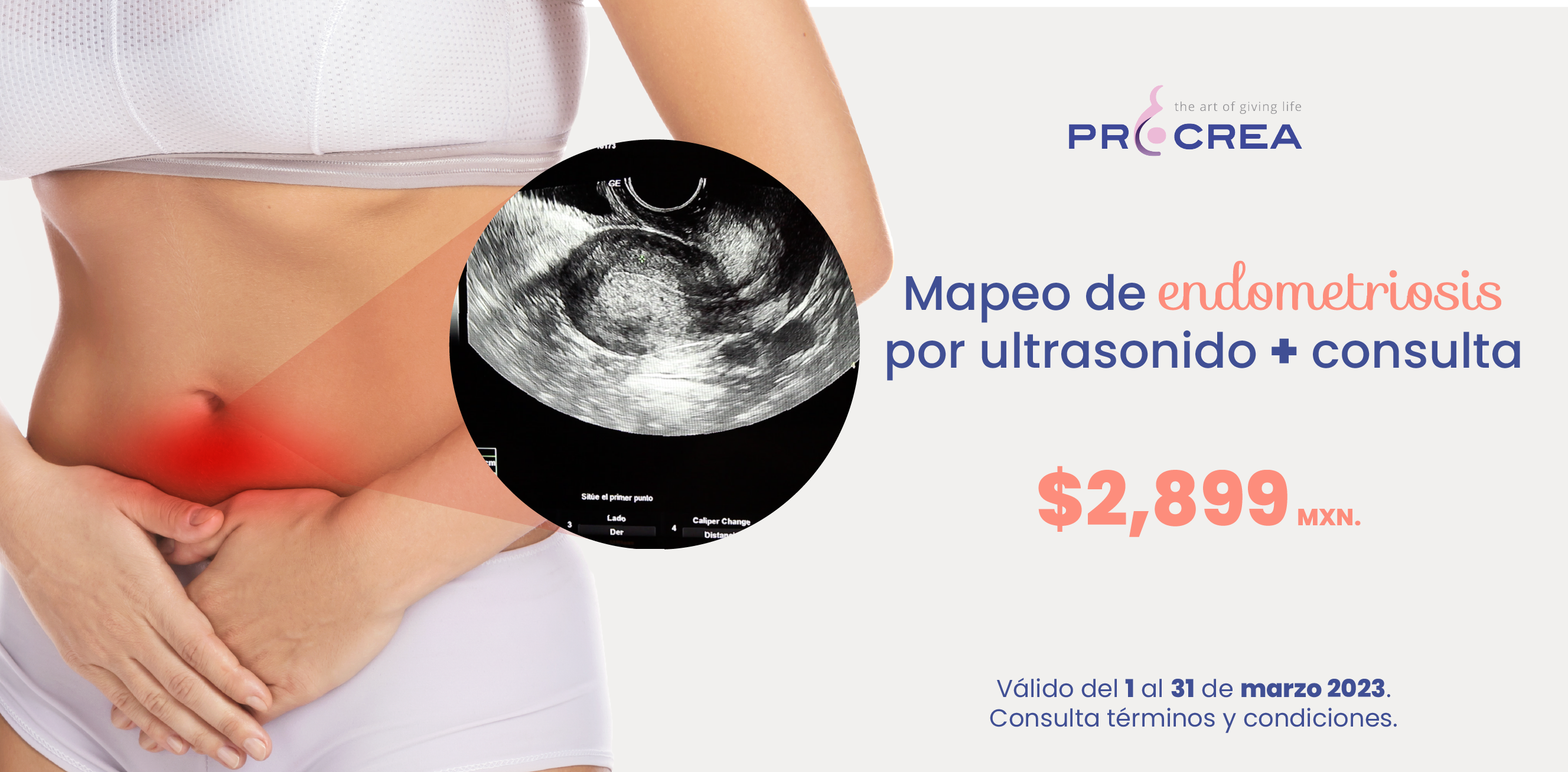 Mapeo de endometriosis por ultrasonido