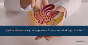 ¿Qué es el varicocele y cómo puede afectar a tu salud reproductiva?