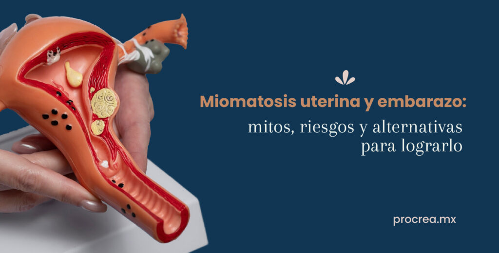 Miomatosis uterina y embarazo: mitos, riesgos y alternativas para lograrlo